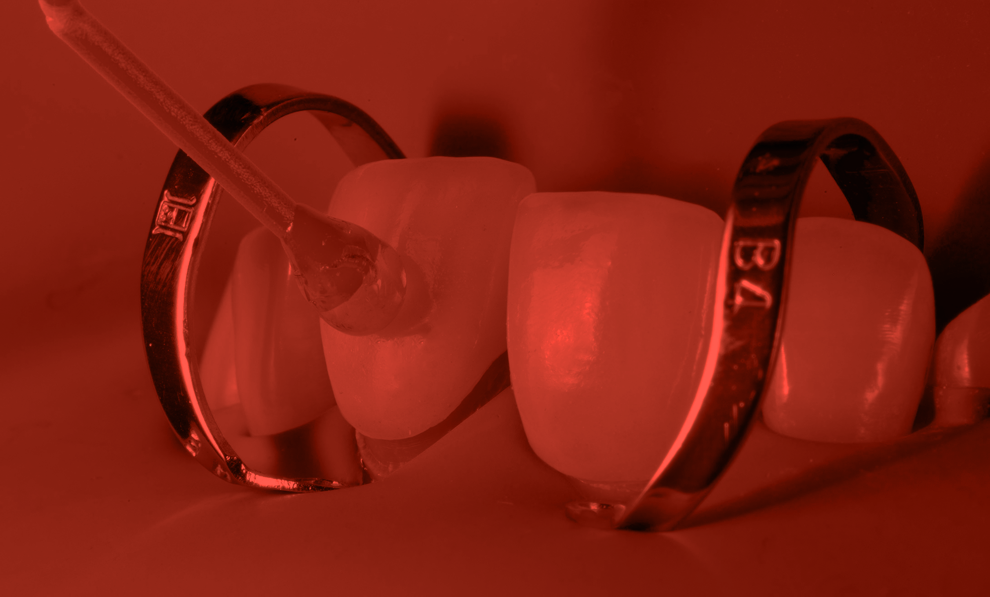 Licówki ceramiczne | kurs dla dentystów - Dental Day