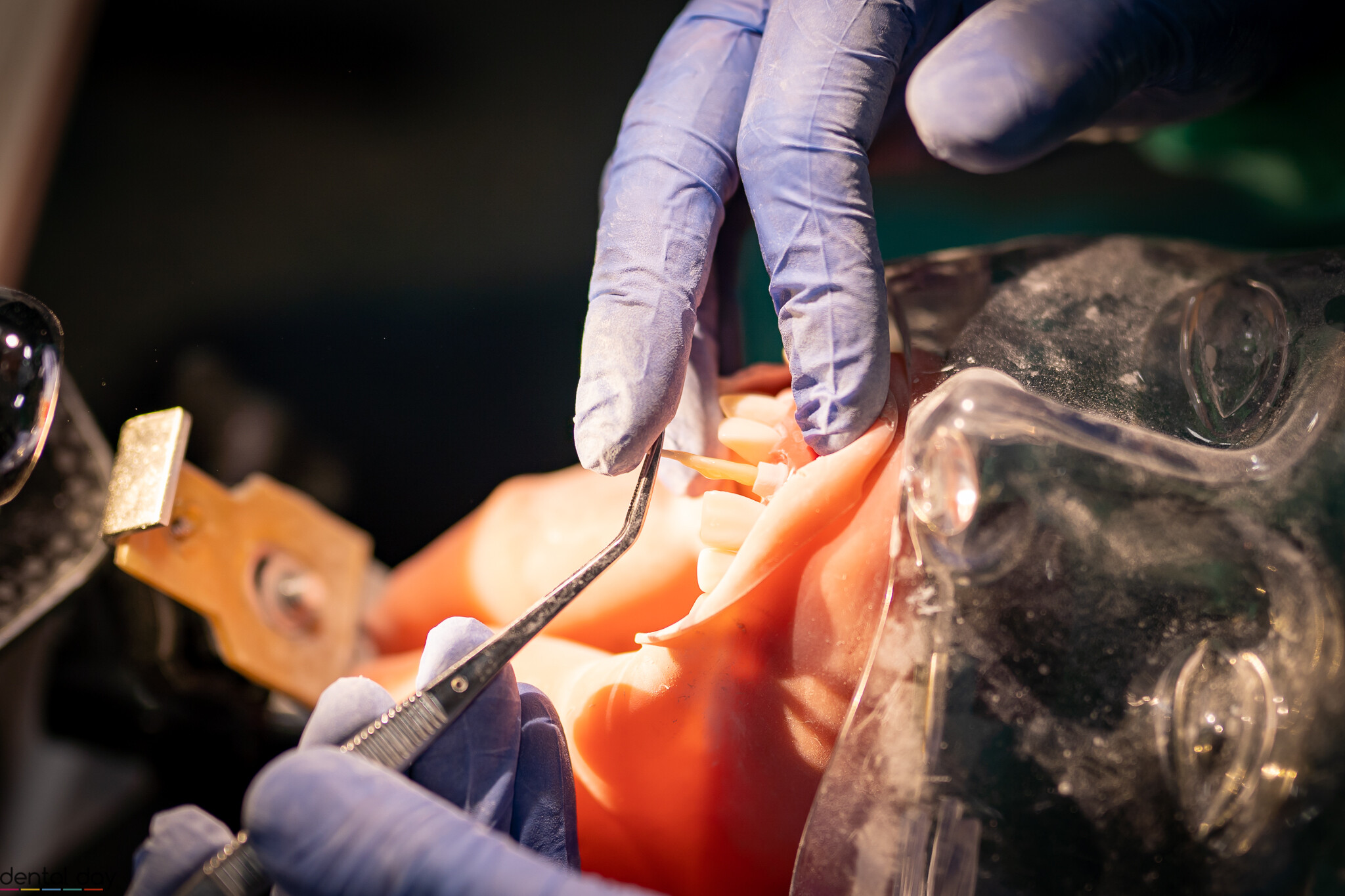 Cementowanie wkładu wkk - Dental Day